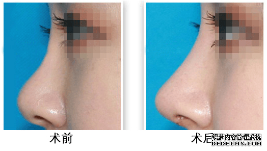 上海硅胶隆鼻手术一般多少钱