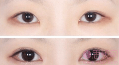 韩式三点定位和埋线双眼皮的区别？