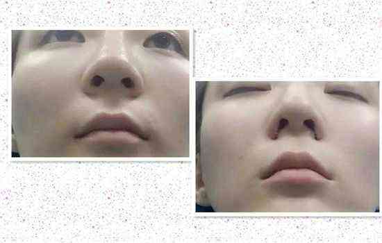 北京做韩式鼻翼缩小手术要多少钱？