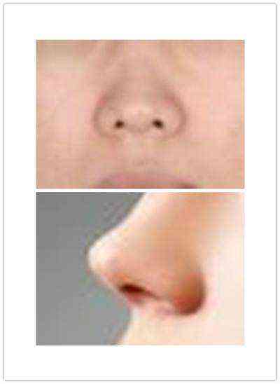 鼻头缩小手术有后遗症吗？