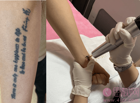 北京军区总医院洗纹身怎么样？附2020价格表一览+洗纹身真人案例一览