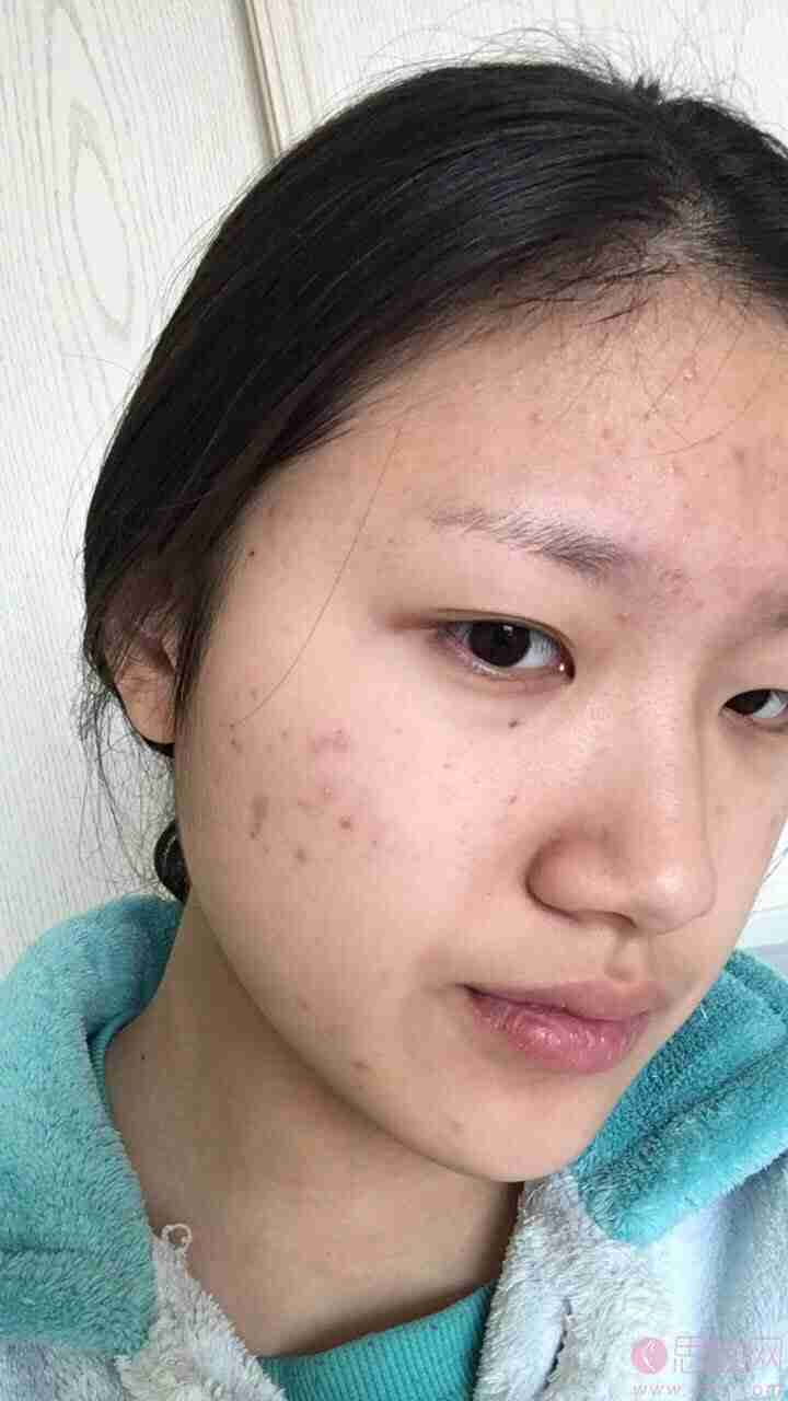 上海第九人民医院激光美容科？收费表一览+激光祛痘真人案例分享