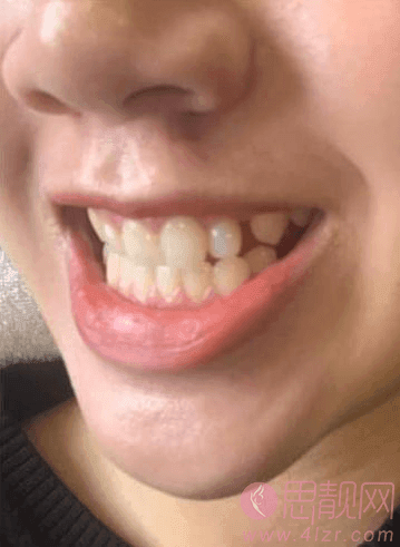 维乐口腔价目表一览+牙齿美白案例分享