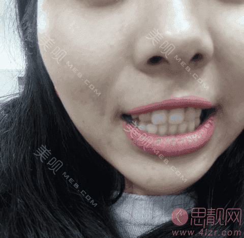 上海摩尔星松口腔医院怎么样？2021收费曝光+牙齿美白案例分享