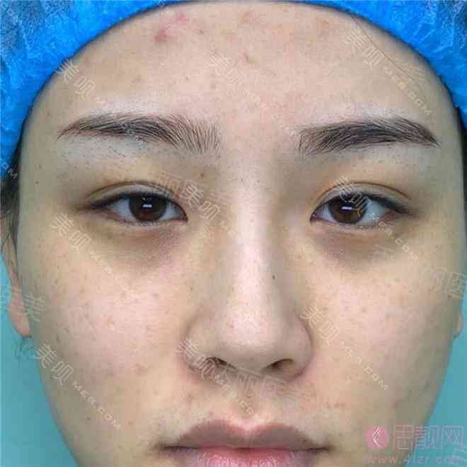 北京百达丽医疗美容怎么样？双眼皮修复案例+2021价格表一览