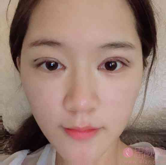 广州韩后医疗美容做双眼皮怎么样？双眼皮真人案例分享+2021价格表公开