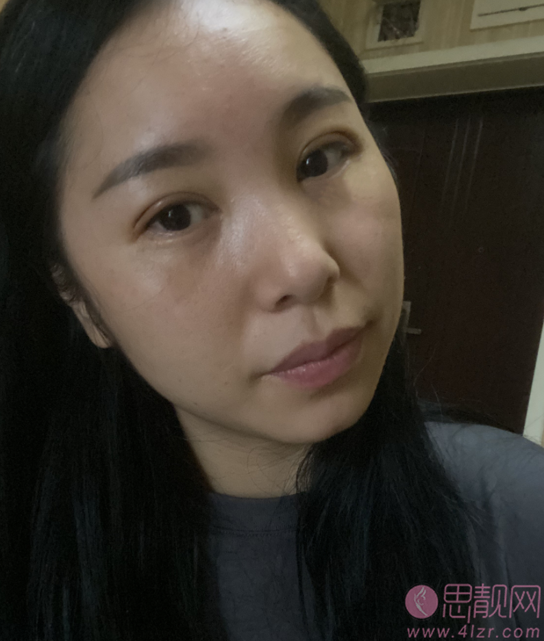 上海朱迪双眼皮修复怎么样?眼修复真人案例分享及恢复过程一览