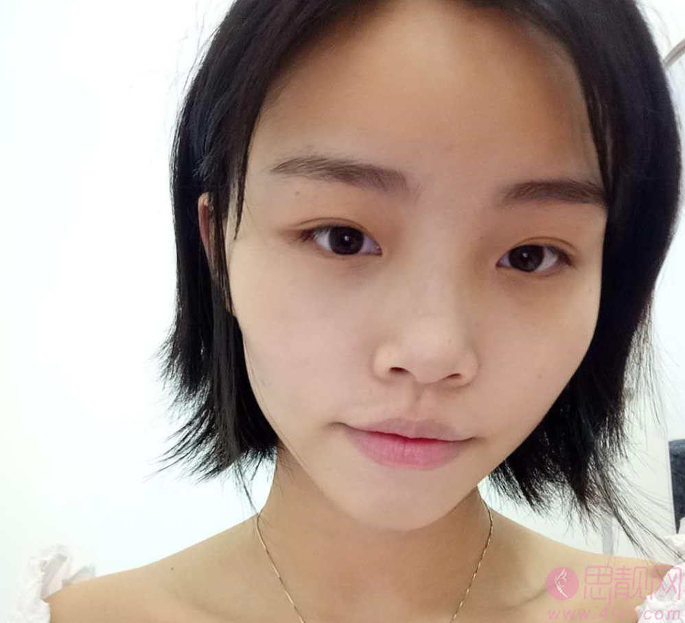 北京医院激光美容外科祛斑怎么样?附祛斑前后果对比一览