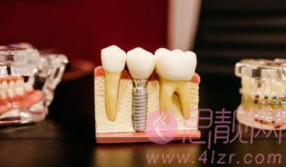 上海种植牙价格多少？贵吗？牙齿种植一般需要做几次？