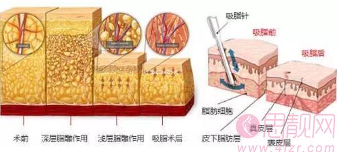 上海九院美容整形抽脂专家谁的技术好？有真人吸脂前后对比图！