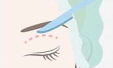 很宽的双眼皮叫什么？名称、效果和手术过程等内容分享