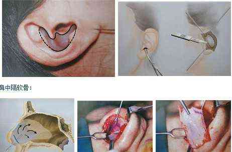 具体如下:1,耳软骨隆鼻后如果出现感染或者血肿时,需要将填充材料取出
