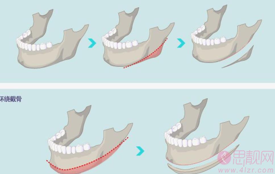 赵绛波做下颌角可信吗？赵医生坐诊医院+下颌角整形对比图曝光！