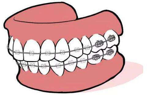 牙齿矫正要几年时间？有没有什么危害？