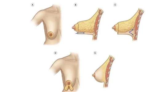 乳房悬吊术究竟是什么?手术步骤拆分，适应症状分析