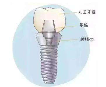 美国百康种植体多少钱一颗？使用寿命有多久？