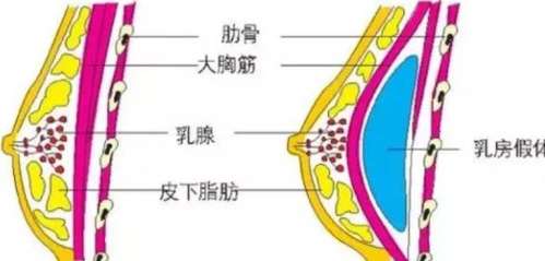 隆胸动漫图01.jpg